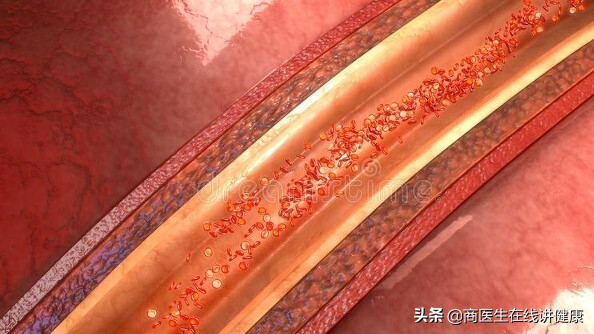 患糖尿病之后，会不会影响性功能？听医生怎么说