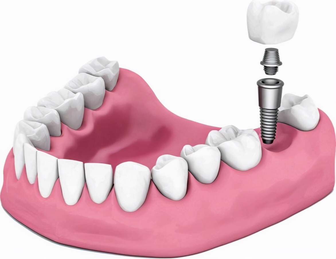「牙齿那些事儿」No.70丨种植牙前植入骨粉会发低热，这是为什么