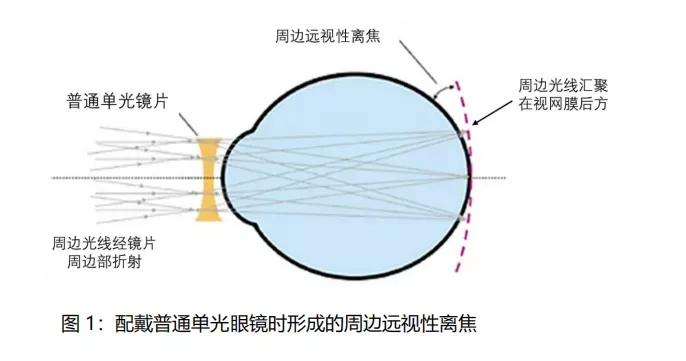 离焦近视眼镜的优缺点-第3张图片-华展网