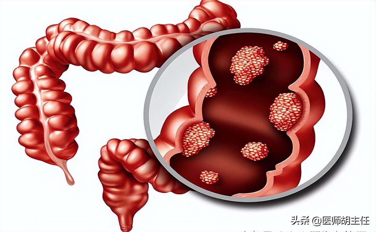 肠癌来临前，会先经历3个症状！劝告：这些高危人群不要忽略