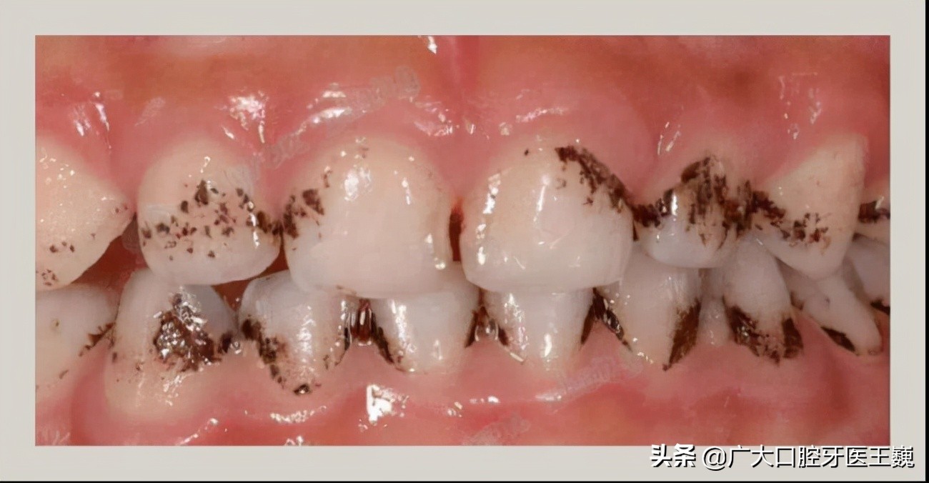 在长期的使用过程中,色素沉积在牙齿上,难以清理