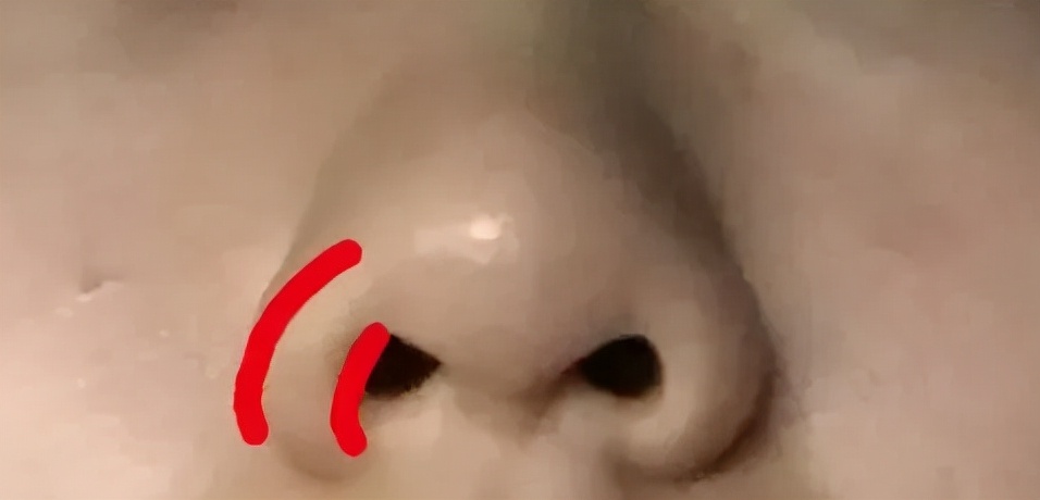 鼻翼肥大的鼻子应该如何改善？