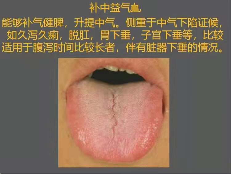 舌有齿痕？脾虚？怎么办