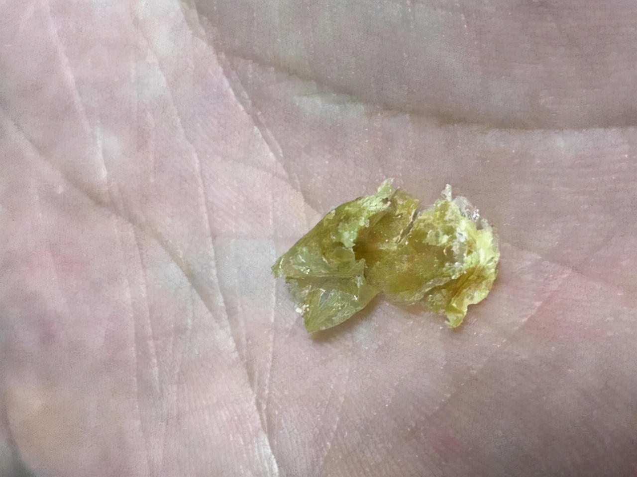 为什么有的人“耳屎”是湿的，有的是干的？或许与这件尴尬事有关