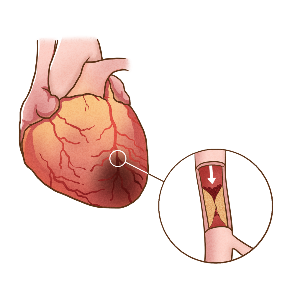熬夜看世界杯猝死（男子因看世界杯猝死，熬夜看球时要注意！别让世界杯综合征找上你）