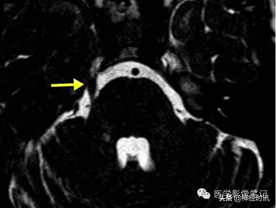 12对脑神经记忆口诀及图谱，别说你没见过