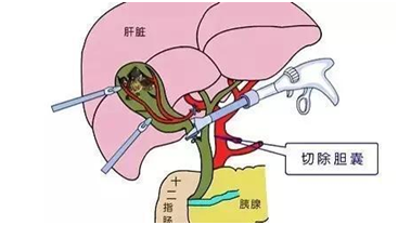 胆囊息肉饮食注意,可以吃什么?不能吃什么?建议收藏(2022版)