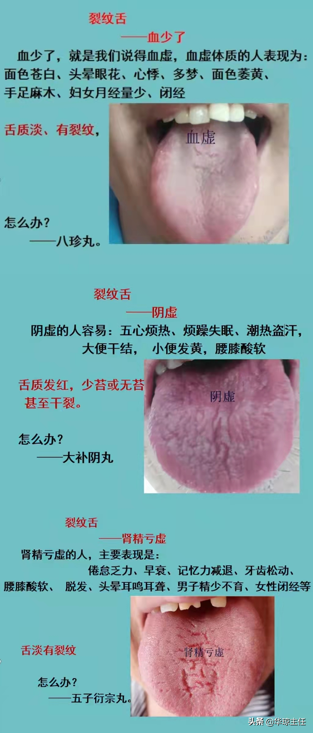 舌有裂纹就是阴虚？四种裂纹舌，十种舌象看看你是属于哪一种？