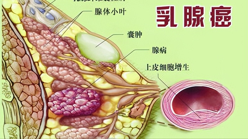 乳房有包块怎么办(房女士的乳腺出现"拳头"般的包块,是乳腺癌?
