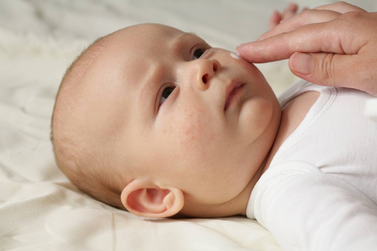 婴儿脸上起红疹子怎么办（不管宝宝长哪种疹子）-幼儿百科-魔术铺