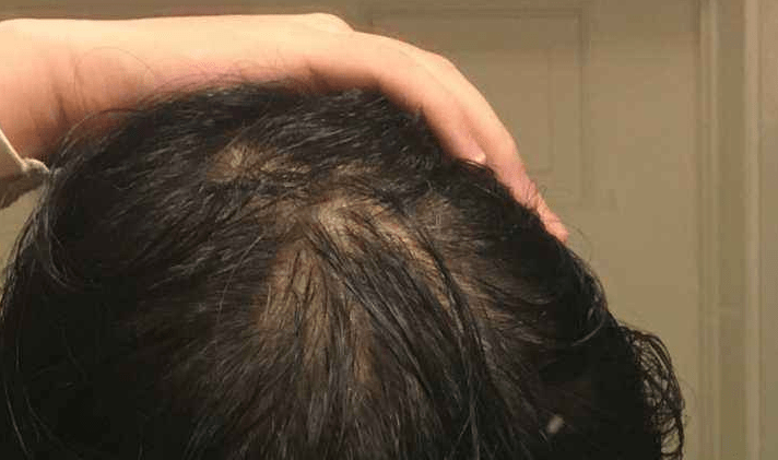 经常感到疲劳、乏力是怎么回事？小心慢性疲劳综合征，查看这5点