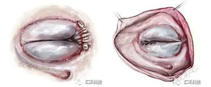 葛均波院士，一天完成三創(chuàng)新醫(yī)械產(chǎn)品首次手術(shù)