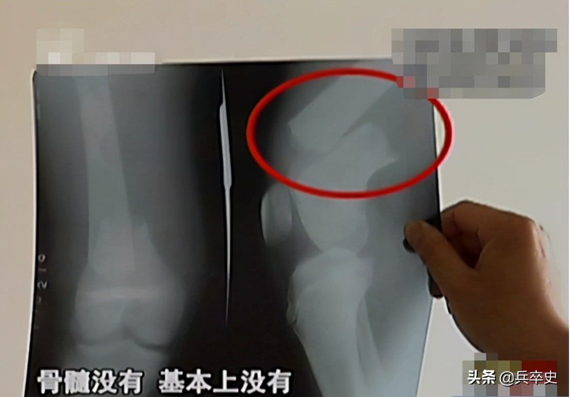 真实故事：山东17岁男孩无痛感汗腺，自我伤害博痛觉，父母泪崩