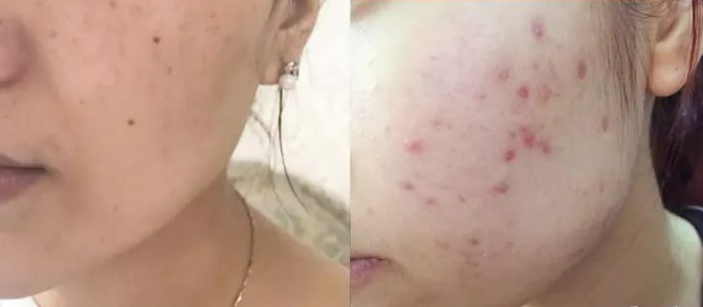 玉蘭油美白祛斑套裝（olay玉蘭油美白套盒，超平價(jià)的美白補(bǔ)水系列！）