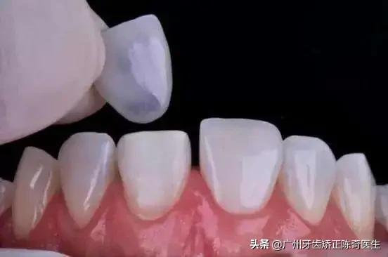 牙黄、牙缝大、牙齿缺损?明星们都在做的牙齿贴面了解一下