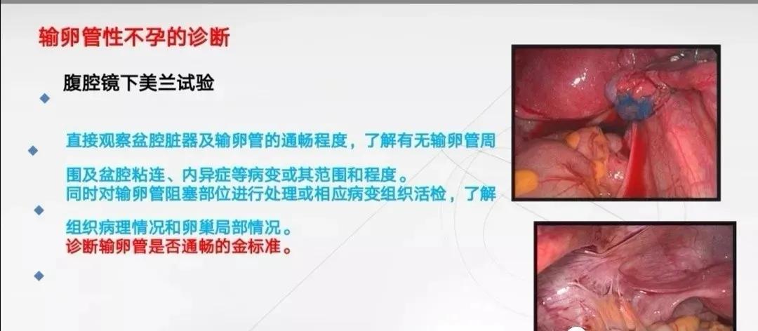 輸卵管造影大概費(fèi)用（輸卵管檢查需要多少錢？輸卵管檢查方法有哪些？）
