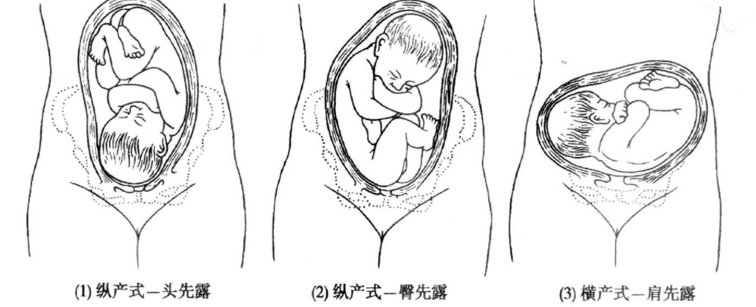 “坐生娘娘立生官，倒立出生最平凡”：其实头位出生才不容易