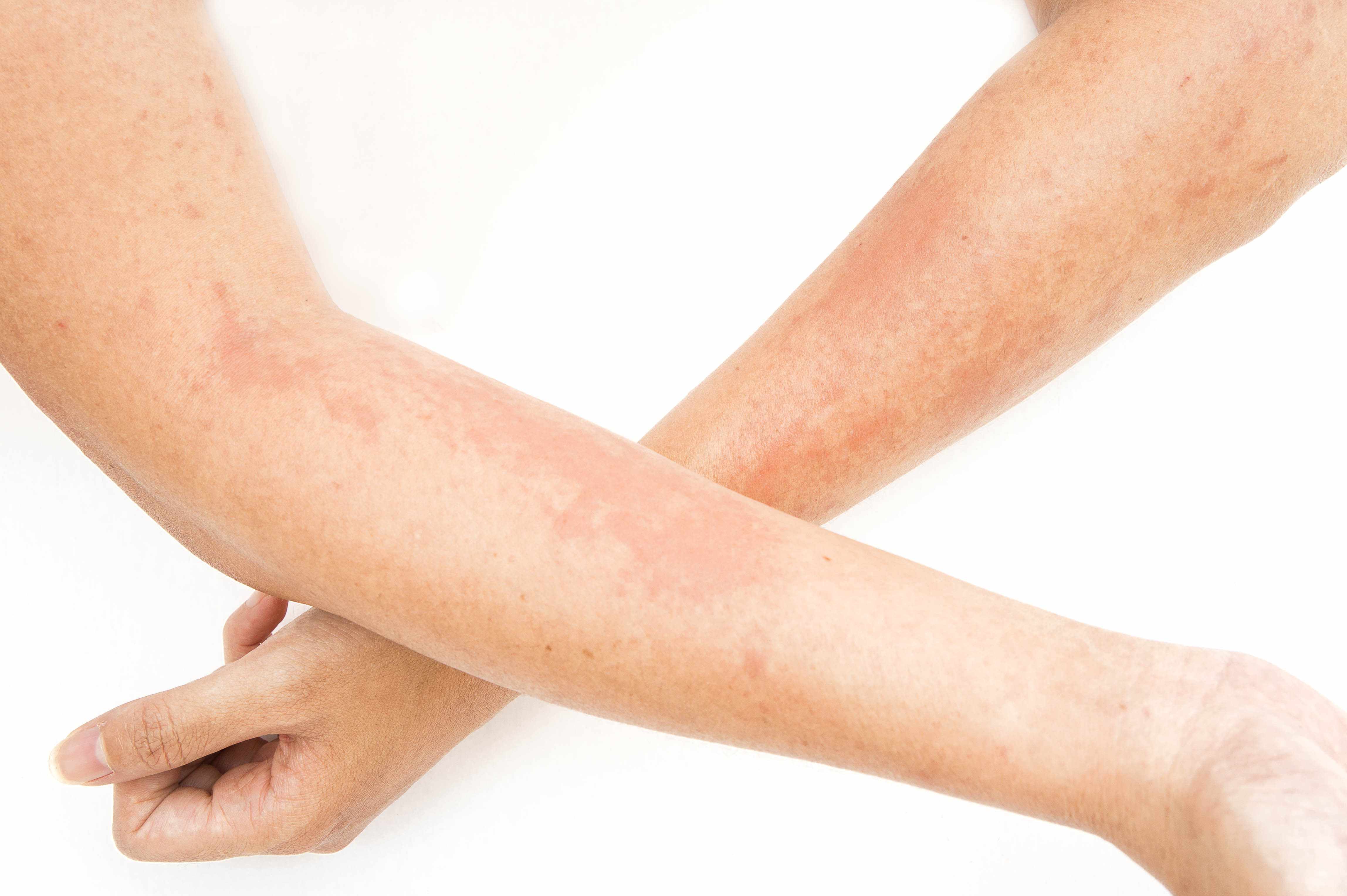 当有了皮肤癌的症状后，不能忽视不管，除了治疗外，还要做好4点