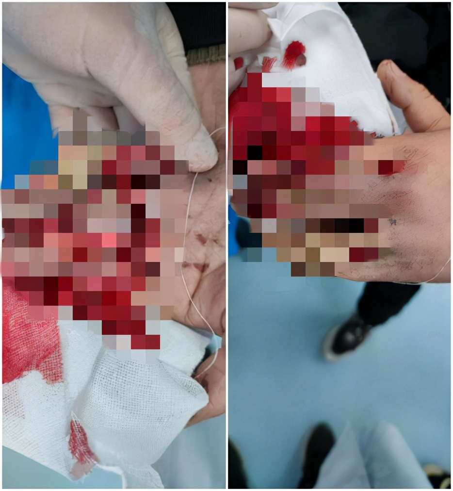 近1个月接收5位手断指患者 医生提醒：临近过年 千万小心别伤了自己