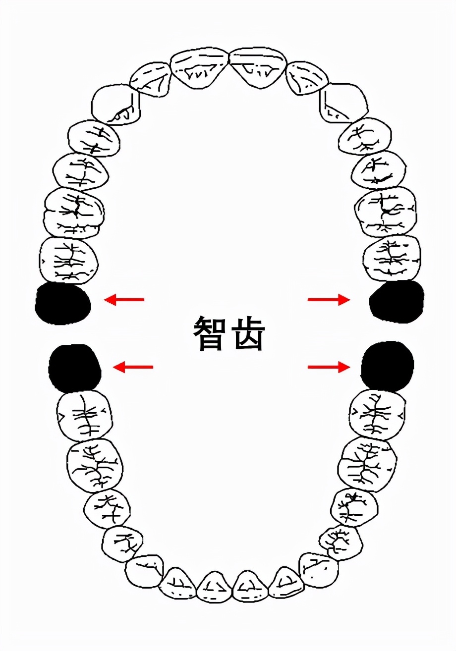 「牙齿那些事儿」No.77丨啊啊啊！智齿为什么会疼啊？该不该拔？