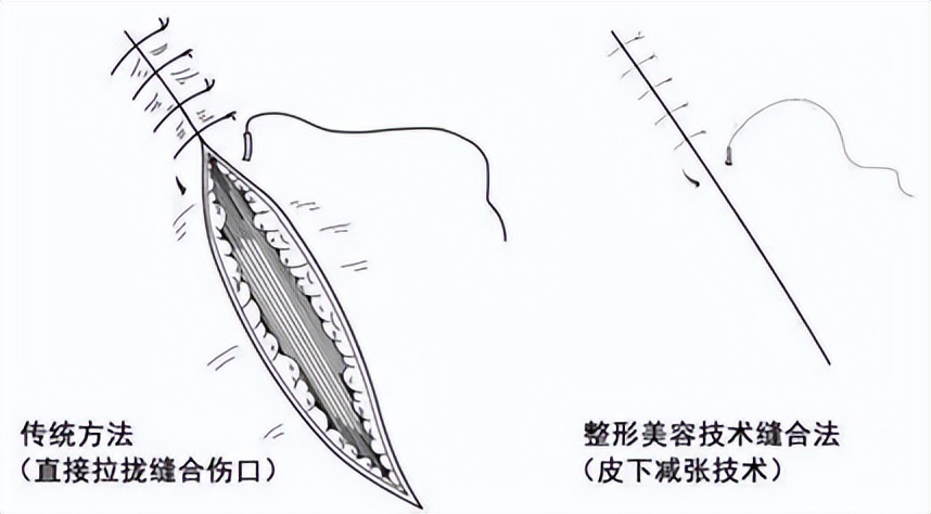 傷口需要縫針 如何才能不留疤痕