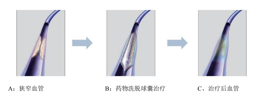 国内冠脉药物球囊第一拟IPO，知名教授创业