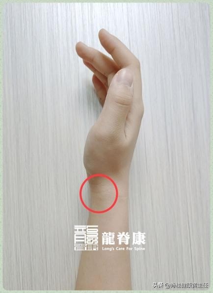 腱鞘炎是怎样产生的？为何女性易遭受其困扰，该如何治疗？