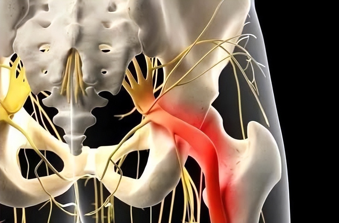 坐骨神经痛的症状 坐骨神经痛症状有哪些-春田百科