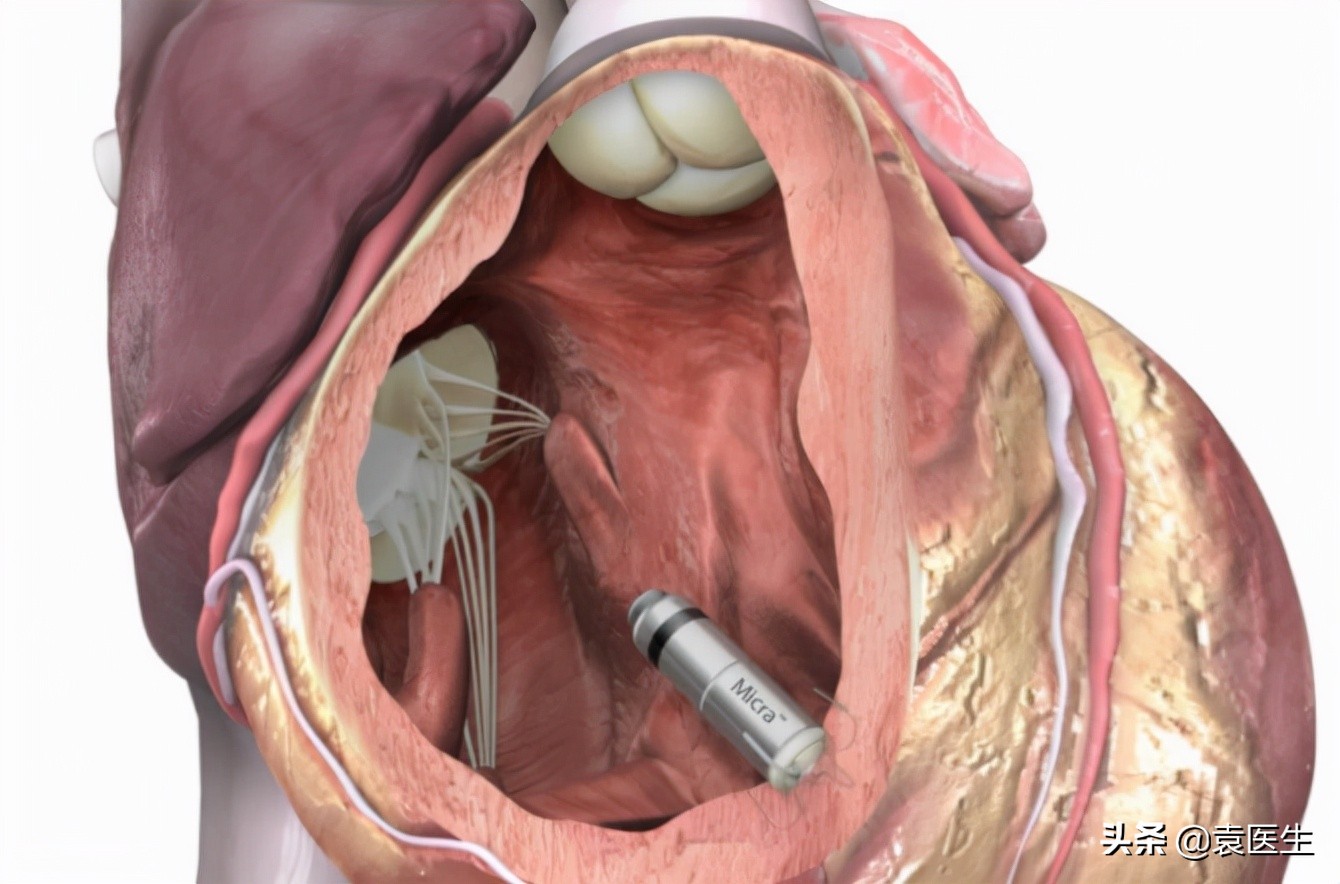 心脏跳得慢怎么办？医生：或要植入“心脏起搏器”