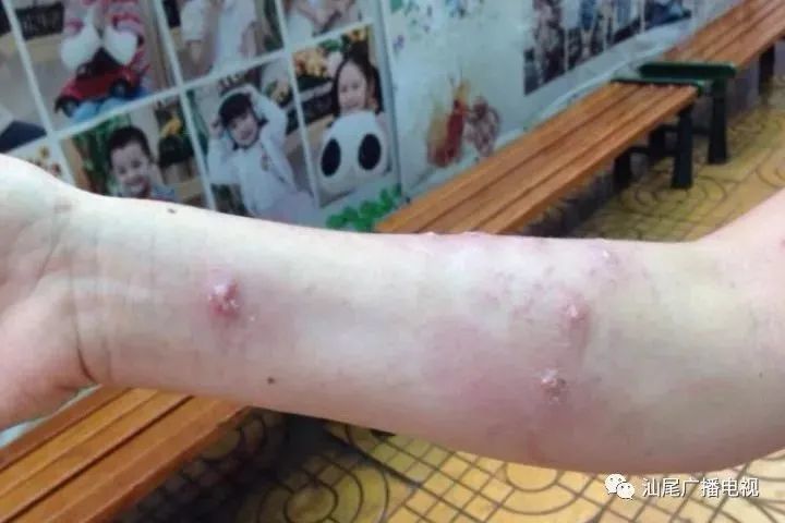 广西13岁男孩被红火蚁咬伤,昏迷不醒,被咬了该怎么办