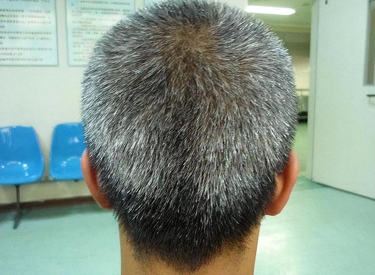如何预防白头发的生长?