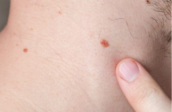 腹股沟长疣图片(颈部出现的神秘) - 赤虎壹号