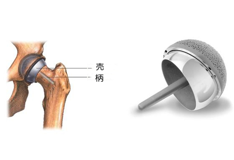 您可能不知道的髋关节表面置换