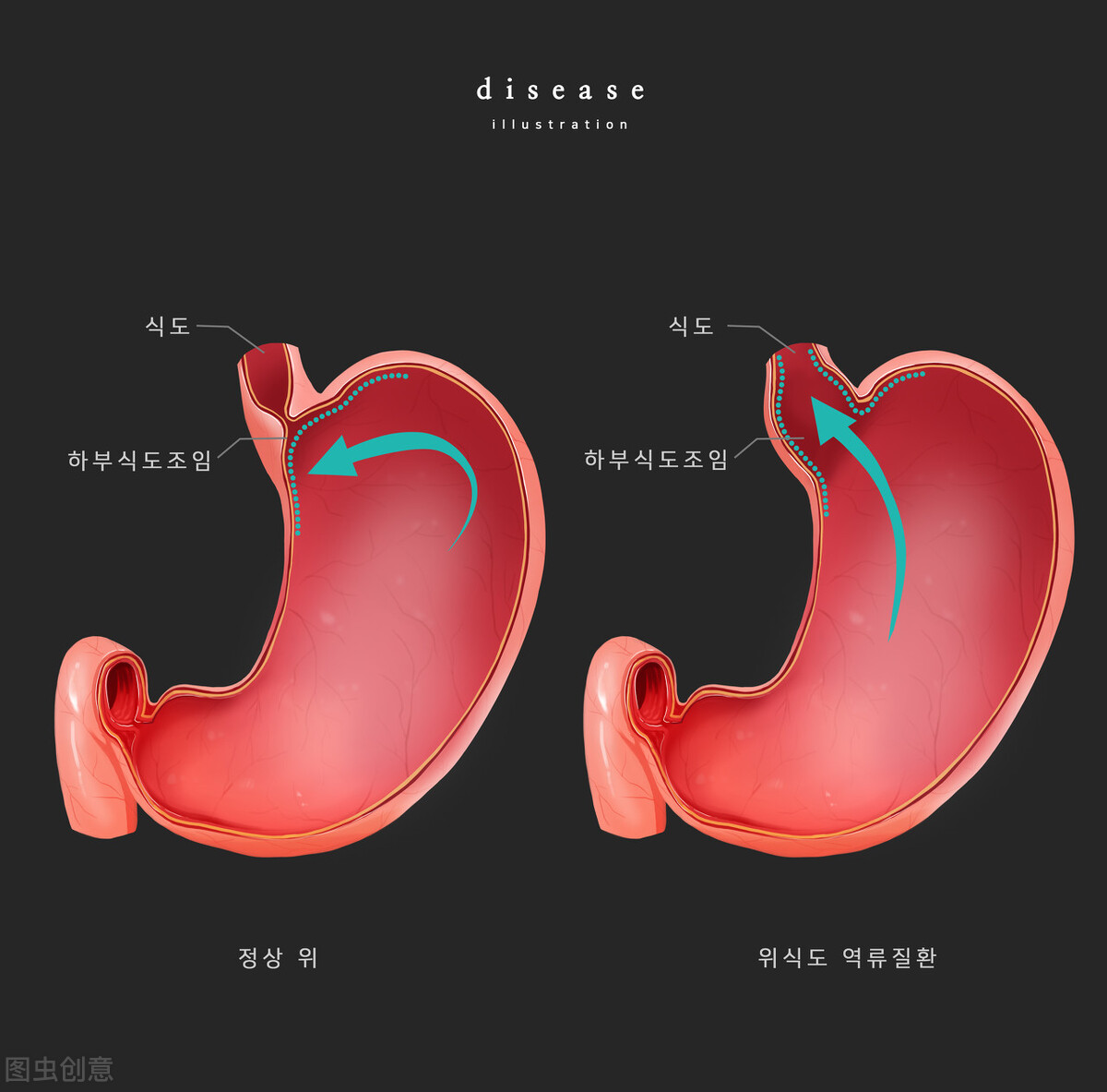 反流性食管炎症状 食管炎a级能治愈吗