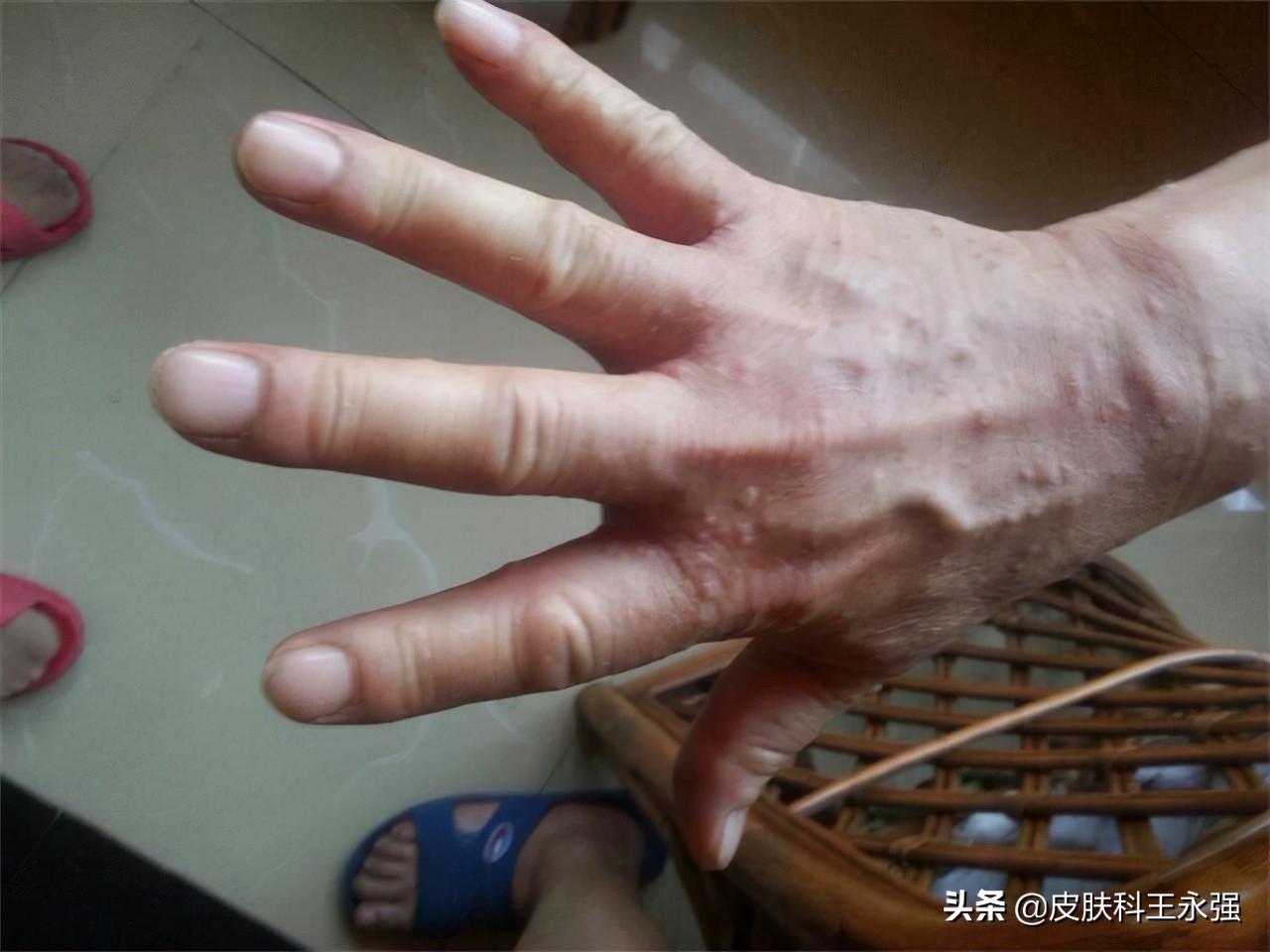 疥螨到底是什么?感染后有何症状?这2种传播途径,男女都要小心