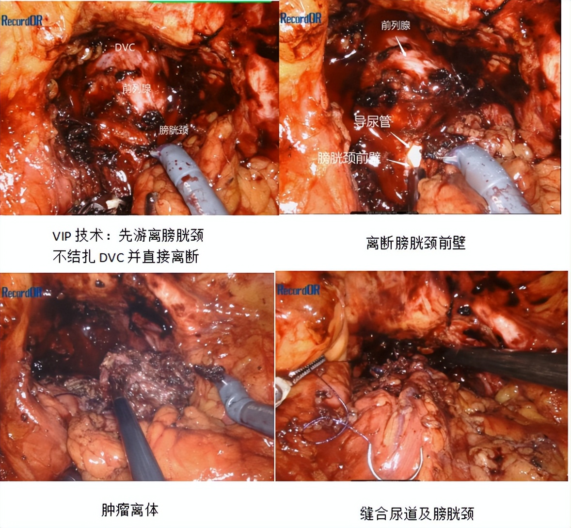 仁医新术| 江西省人民医院首创机器人腹腔镜下经腹膜外入路“三臂法”前列腺癌根治术