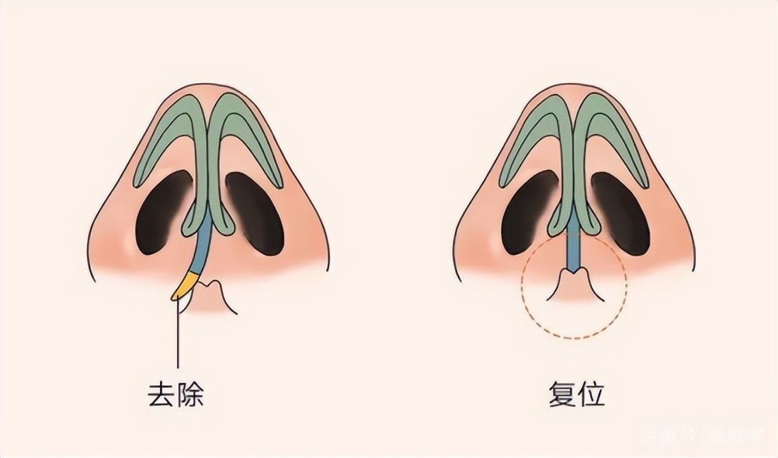 陈国成：歪鼻就是鼻子歪了，但是你知道其实矫正并不难吗？
