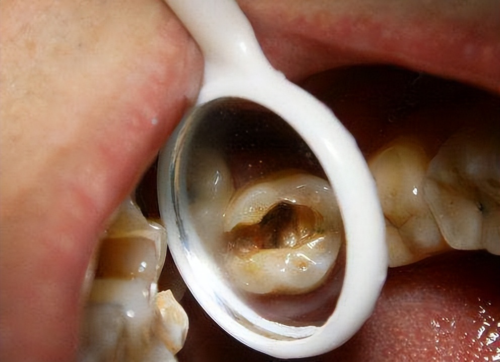 牙齿坏掉图片(3个办法轻松判断牙髓是否坏死) - 赤虎壹号