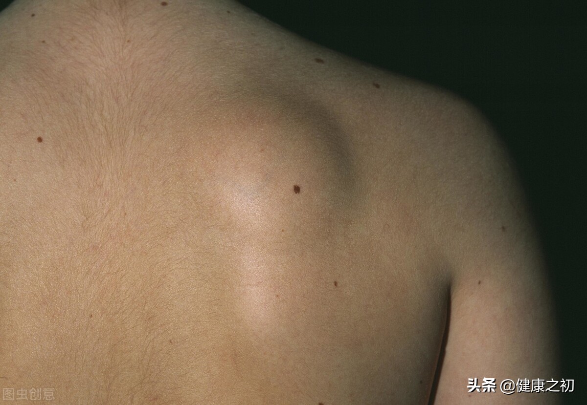 身上长满脂肪瘤怎么办？全身肉疙瘩影响生活