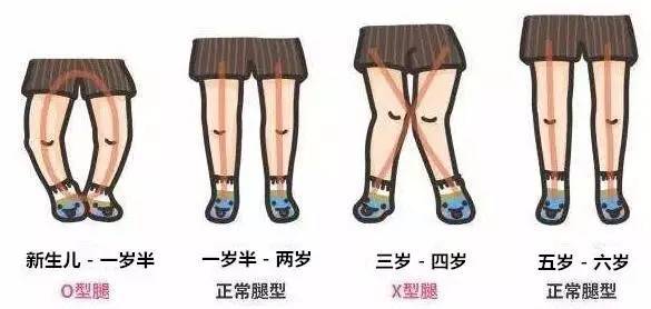 宝宝出现o型腿,尿不湿:这个锅我可不背