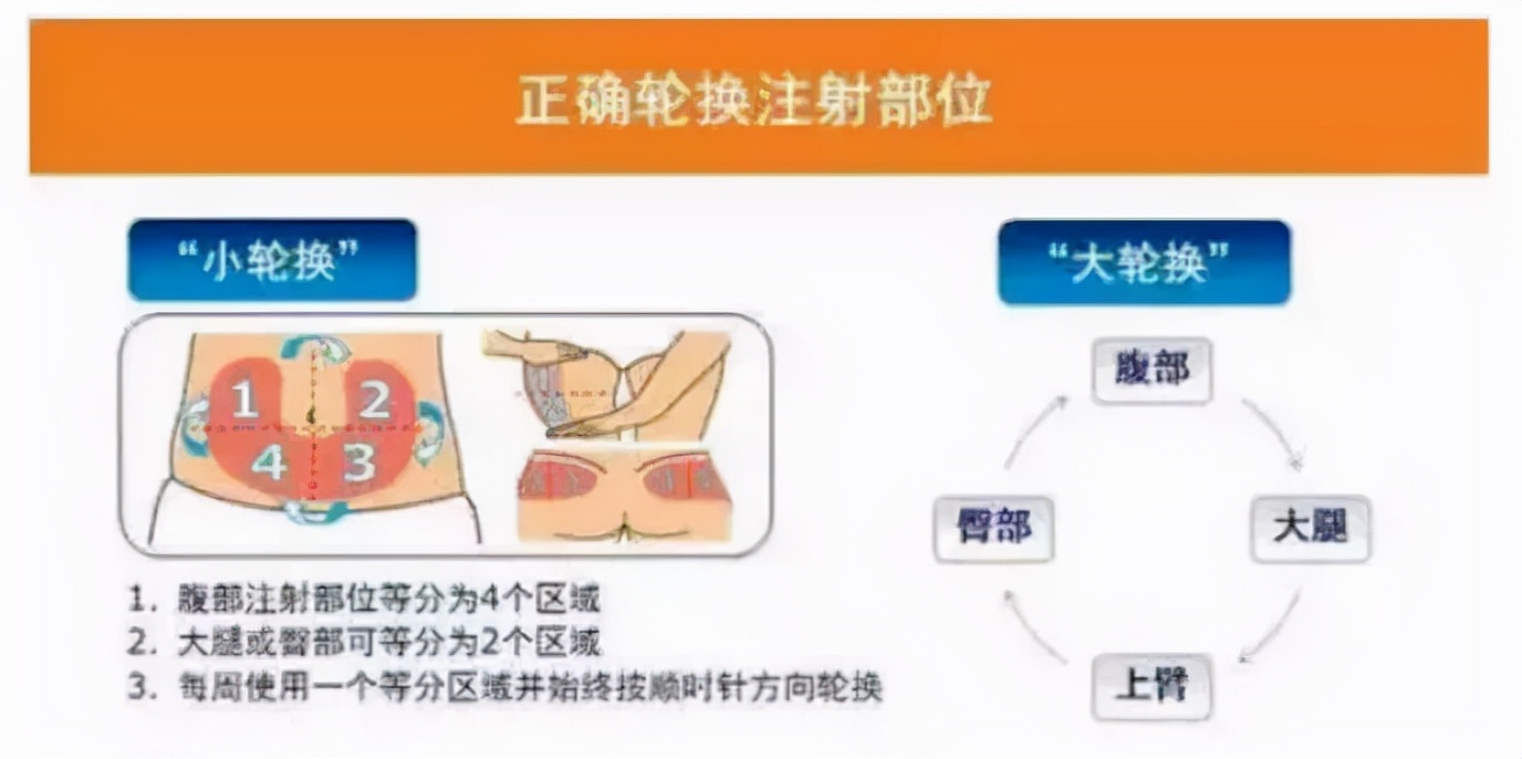 肝素注射卡位图图片