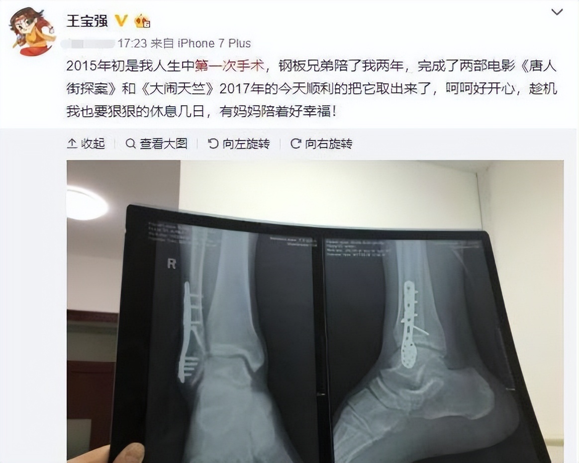 杨幂新综眼角受伤险毁容!王宝强摔断腿李晨缝22针,