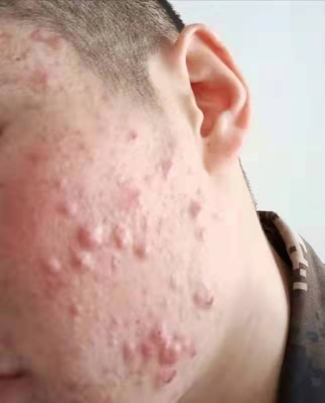 硬结性痤疮(长痘后留下硬块怎么办)