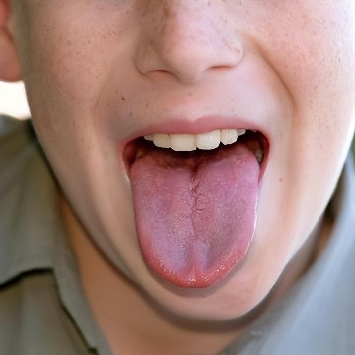 舌头中间有裂纹是怎么回事（舌头中间有裂纹，是身体哪里出现了问题？）