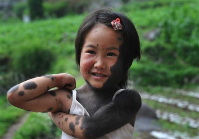 女孩60%皮肤布满黑毛,2岁遭父母抛弃,被同龄人取"小猴子"外号