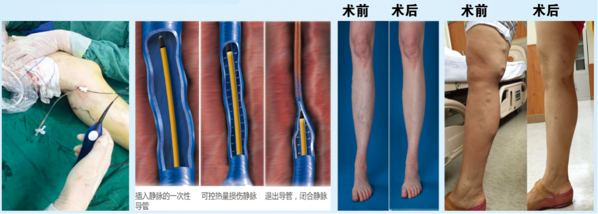不打烊 更方便 周围血管科（介入科）开设周六全天门诊