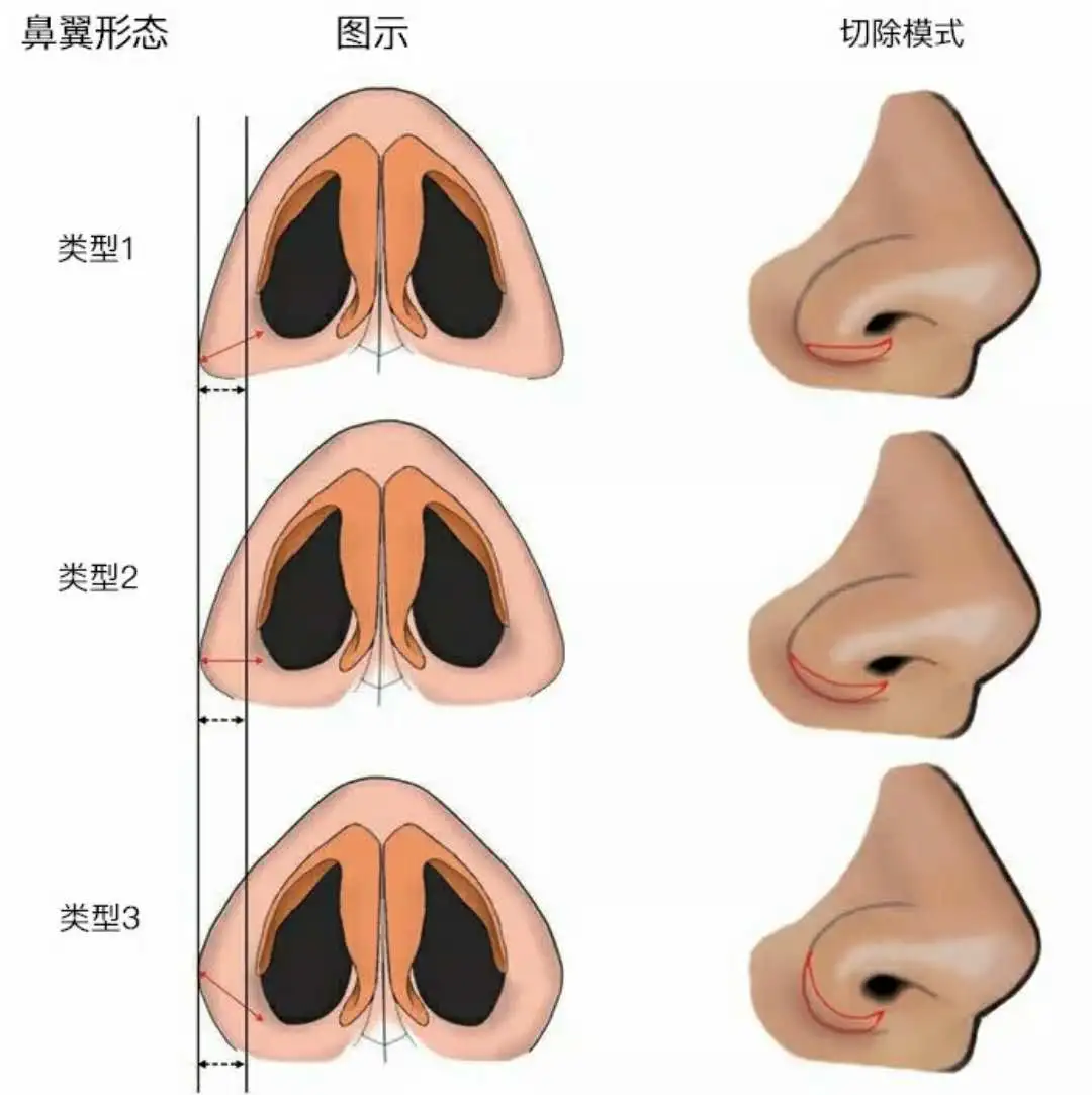 鼻翼肥大的鼻子应该如何改善？