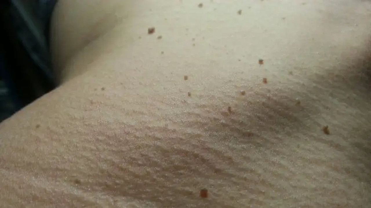 脸上,颈部,腋下的"肉疙瘩"是如何产生的?能用手抠掉吗?