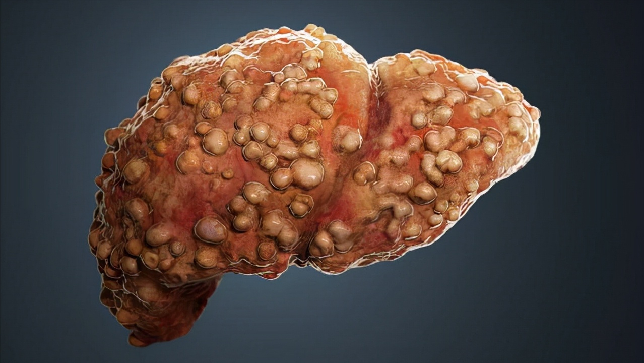 发现早期肝癌，检测甲胎蛋白是关键？肝病医生：这些检查同样重要