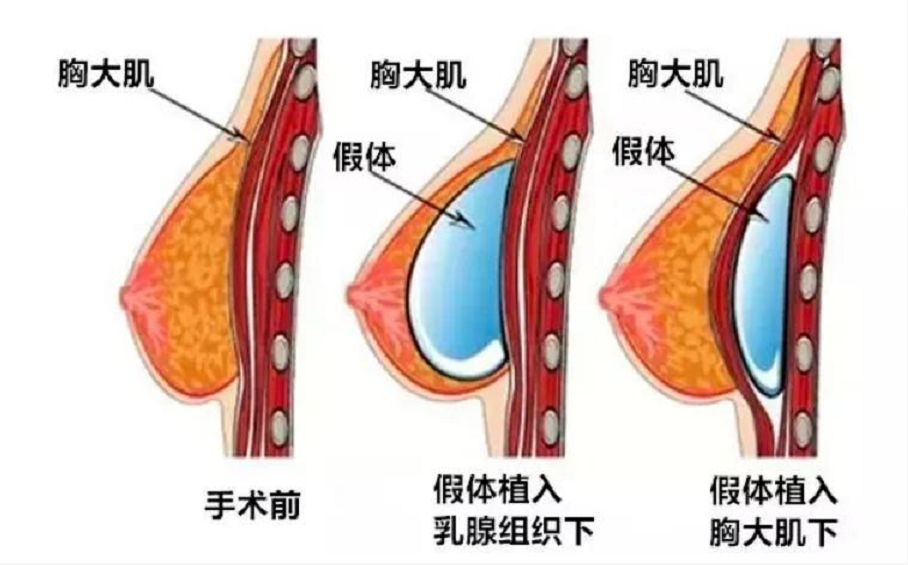 女子花4.8万隆胸，术后“硬得推不动”！为什么会发生这样的事？